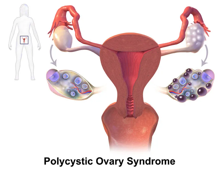 Pcod Polycystic Ovary Syndrome
