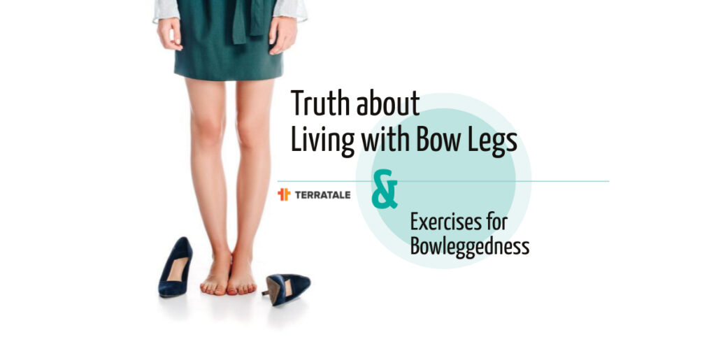 The Truth About Living With Bow Legs (Genu Varum) + 7 Exercises For Bowleggedness